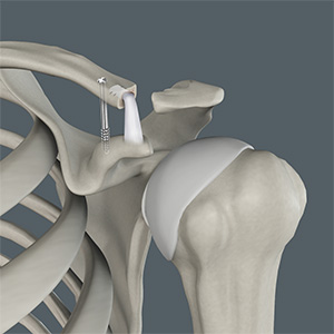 AC joint reconstruction