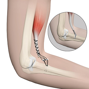 Distal Bicep Repair