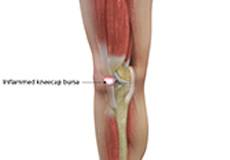 Kneecap Bursitis